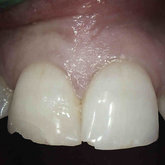 Photo of tooth before extraction