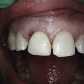 Photo of tooth crown placed on implant