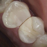 Large composite fillings and insufficient contact between two teeth
