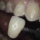 Taking the correct shade of the tooth