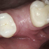 After implant placement and bone augmentation