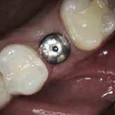 Healing abutment in place