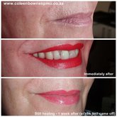 Full lips, remember the colour will soften when healed.
