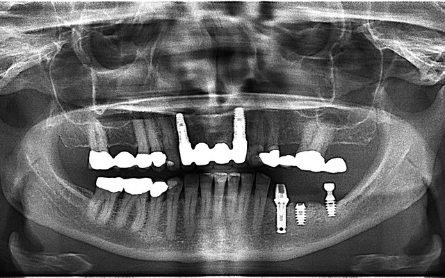 PAN showing crowns and bridges (white blobs) and implants (screws)