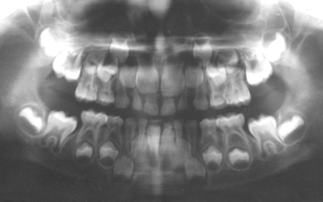 PAN of childs mouth showing primary and permanent teeth