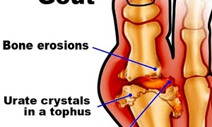 How to prevent gout?