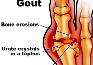 How to prevent gout?