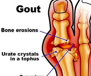 How to prevent gout?