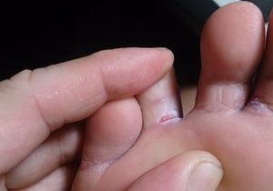 Do you have athlete's foot?