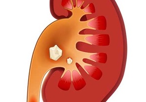 Hoe om nierstene uit te skei