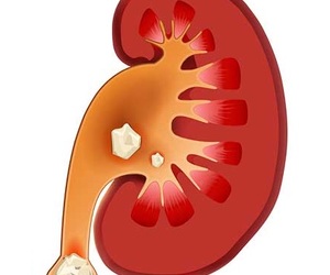 Hoe om nierstene uit te skei