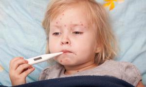 Know the risks of chicken pox