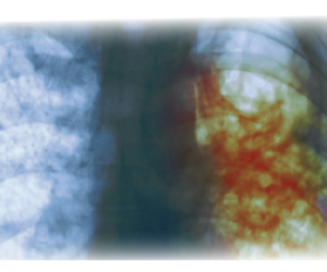 What To Do If You Have Been Exposed To TB