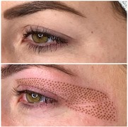 Plasma Pen Coming Soon!