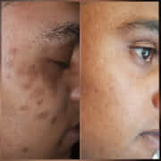 Skin Pigmentation