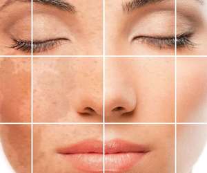 Natural remedies for the skin