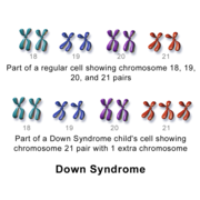 Wat is Downsindroom?