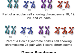 Wat is Downsindroom?