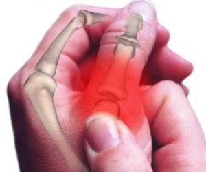 Voedsel wat met artritissimptome kan help